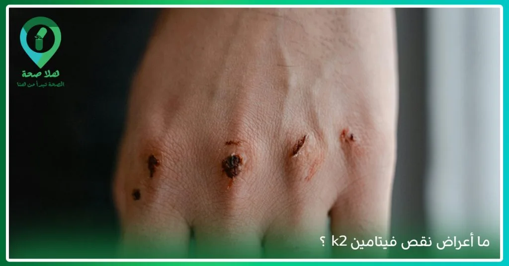 ما هي أعراض نقص فيتامين K2؟ وماذا يسبب نقص فيتامين K2
