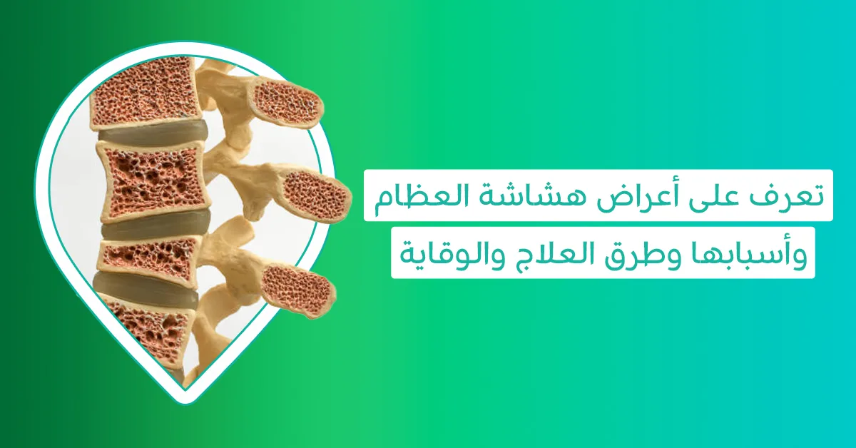 اعراض هشاشة العظام-علاج هشاشة العظام-أدوية هشاشة العظام-أفضل حبوب هشاشة العظام